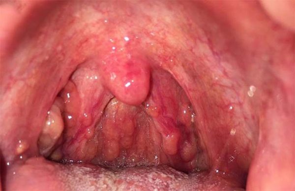 bệnh viêm họng hạt