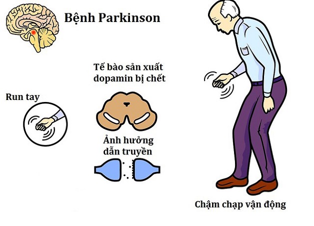 3. Mức độ nguy hiểm của bệnh Parkinson