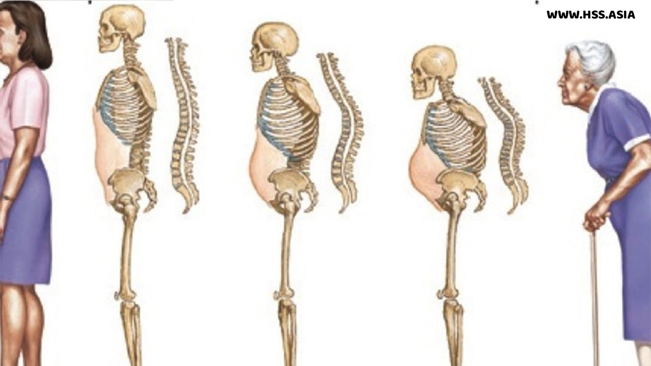 Tại sao việc giảm chiều cao có thể là dấu hiệu của loãng xương ở người già?
