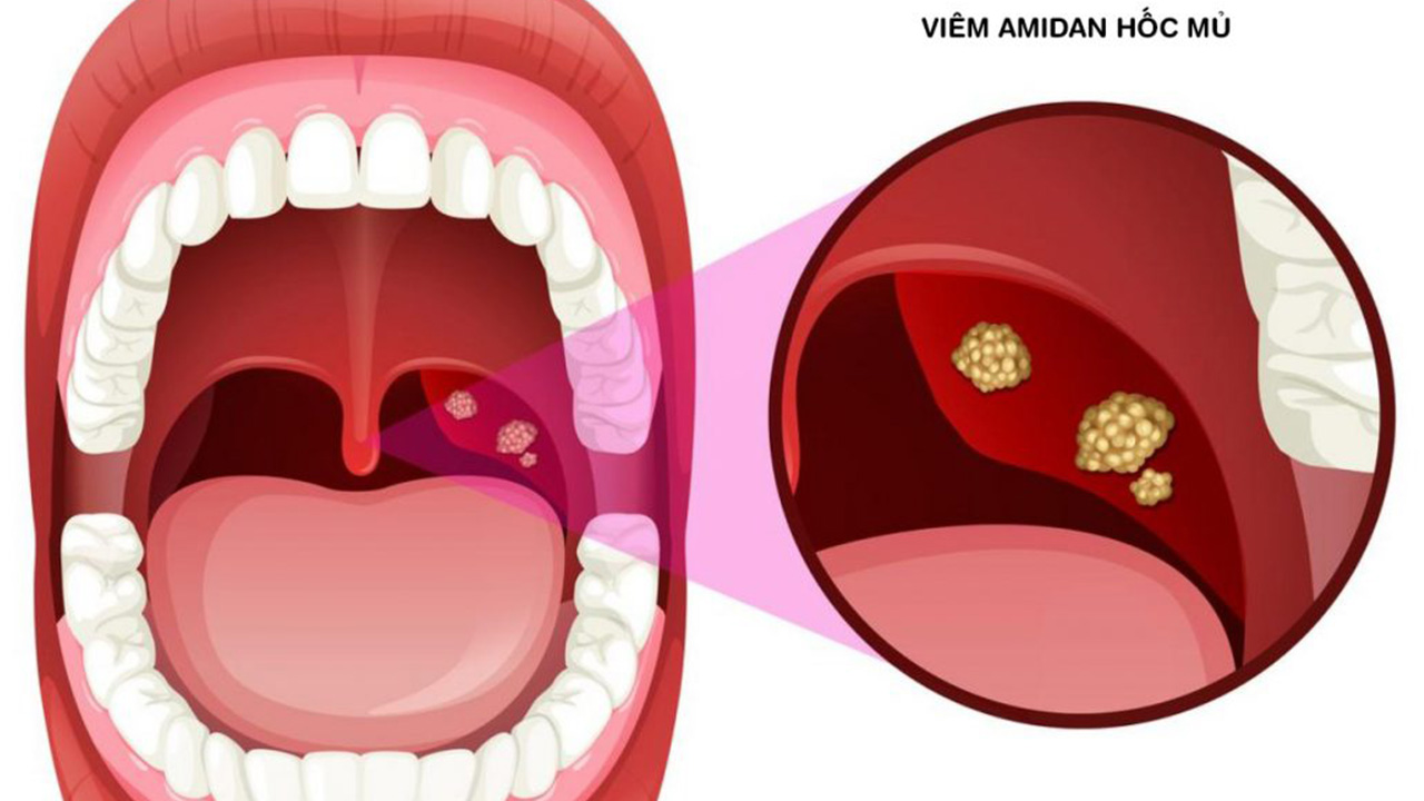 Phòng Ngừa Nhiệt Amidan