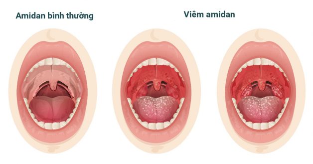 Cắt amidan cho trẻ nên thực hiện khi nào và như thế nào? | TCI ...