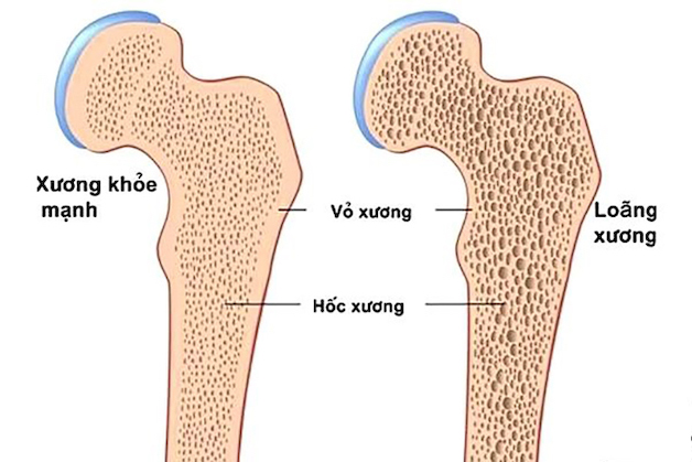 Biến Chứng Do Xương Xốp Gây Ra