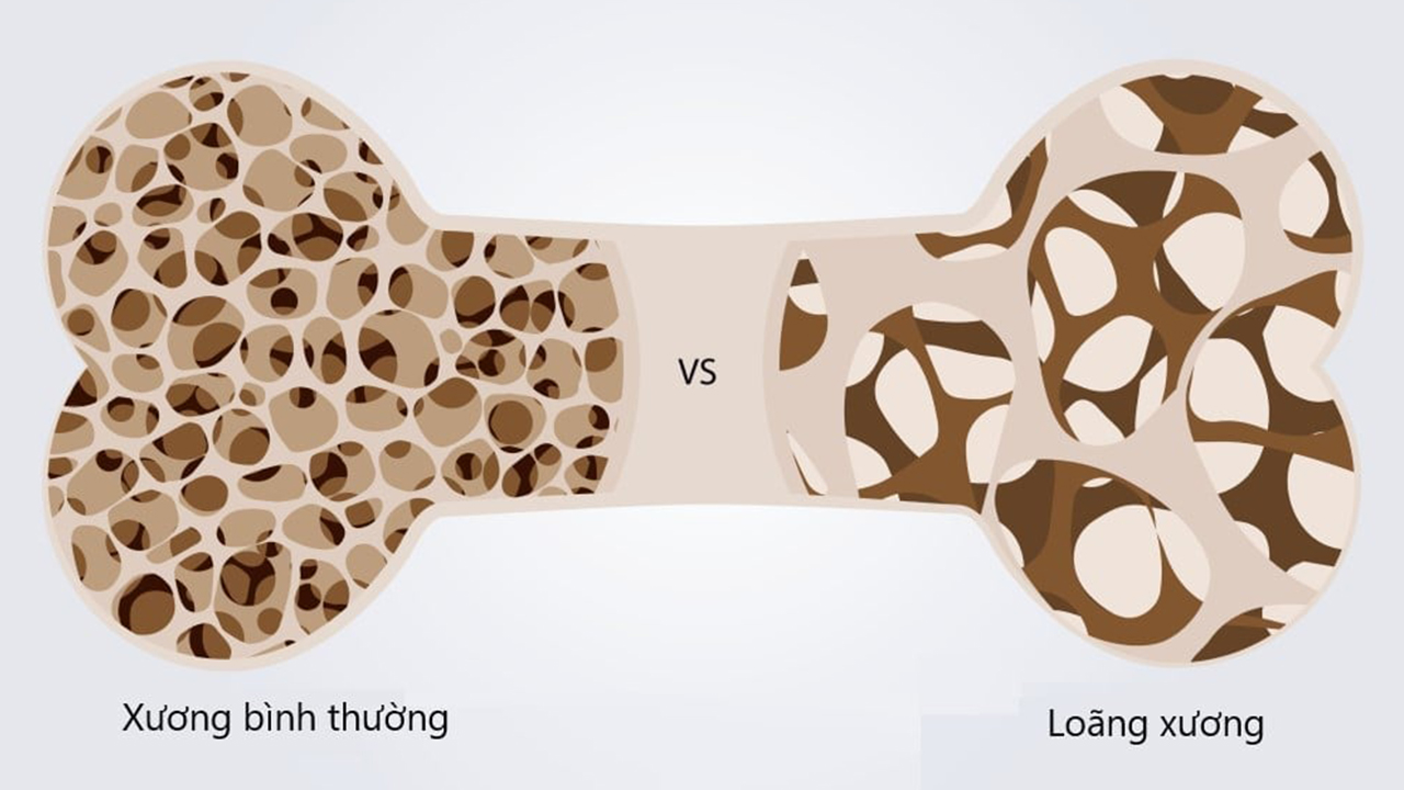 Cơ chế loãng xương được diễn ra như thế nào? | TCI Hospital