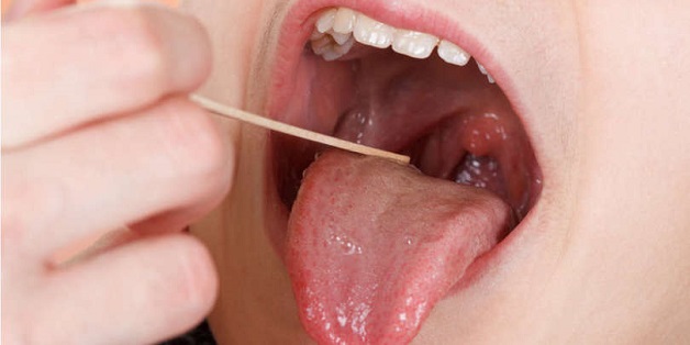 Dấu hiệu ung thư vòm họng và cách điều trị phẫu thuật