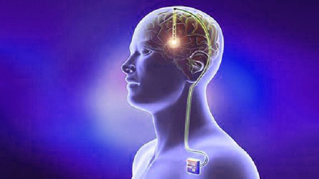 điều trị bệnh parkinson bằng phương pháp phẫu thuật kích thích não sâu
