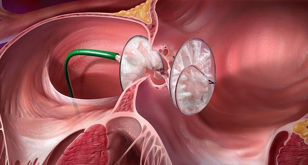 Bít lỗ thông bằng dụng cụ hoặc phẫu thuật là những biện pháp điều trị trong những trường hợp thông liên nhĩ nặng.