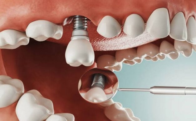 Răng giả implant này gồm 3 bộ phận: Trụ implant được làm bằng chất liệu titanium lành tính, mão răng sứ được lắp trên cùng và khớp nối abutment