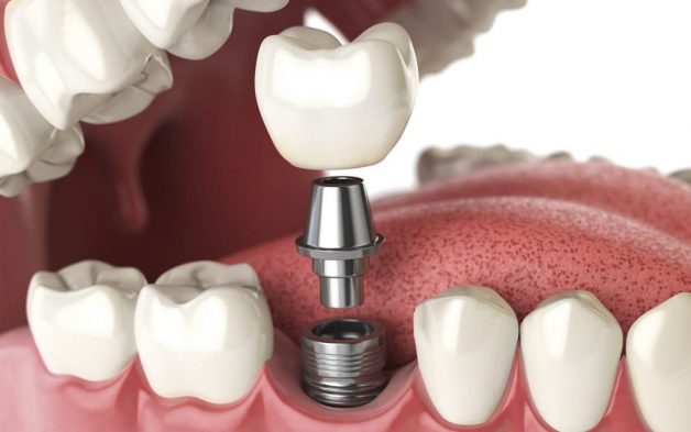 Răng implant gồm 3 phần là trụ implant, khớp nối abutment và mão răng sứ