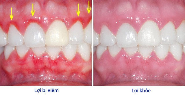 Giải đáp: Khi bị viêm lợi phải làm sao? | TCI Hospital