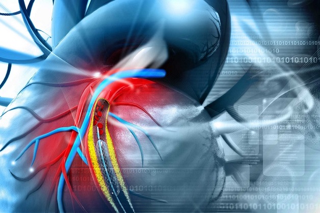 Đặt stent là biện pháp can thiệp cần thiết để điều trị bệnh hẹp động mạch vành khi các triệu chứng đã trở nên quá nặng, điều trị nội khoa không đáp ứng.