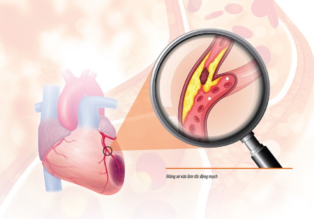 Xơ vữa động mạch và huyết khối là những nguyên nhân hàng đầu gây tắc động mạch vành.