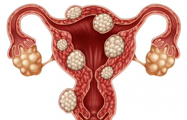 Nhân xơ tử cung là một dạng nhân xơ xuất phát từ cơ tử cung, đa phần các khối nhân xơ đều là lành tính, không phải ung thư.