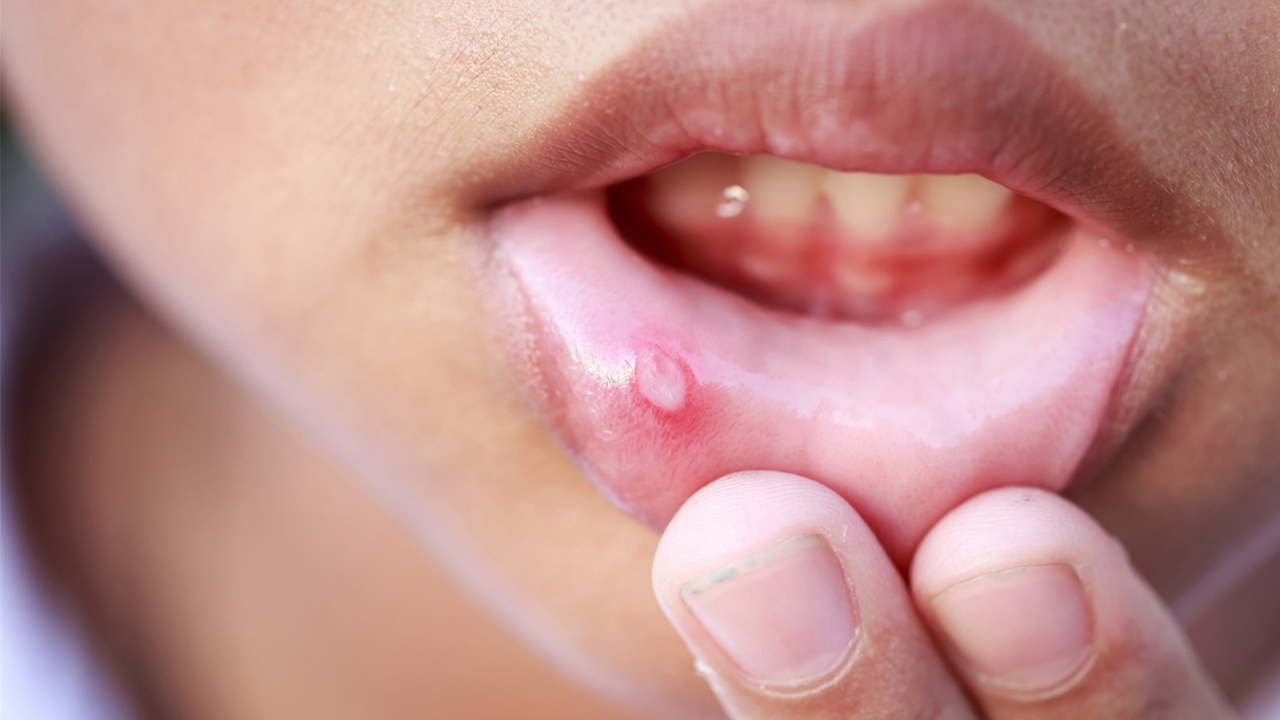  Bị lở miệng ở môi : Nguyên nhân và cách điều trị hiệu quả