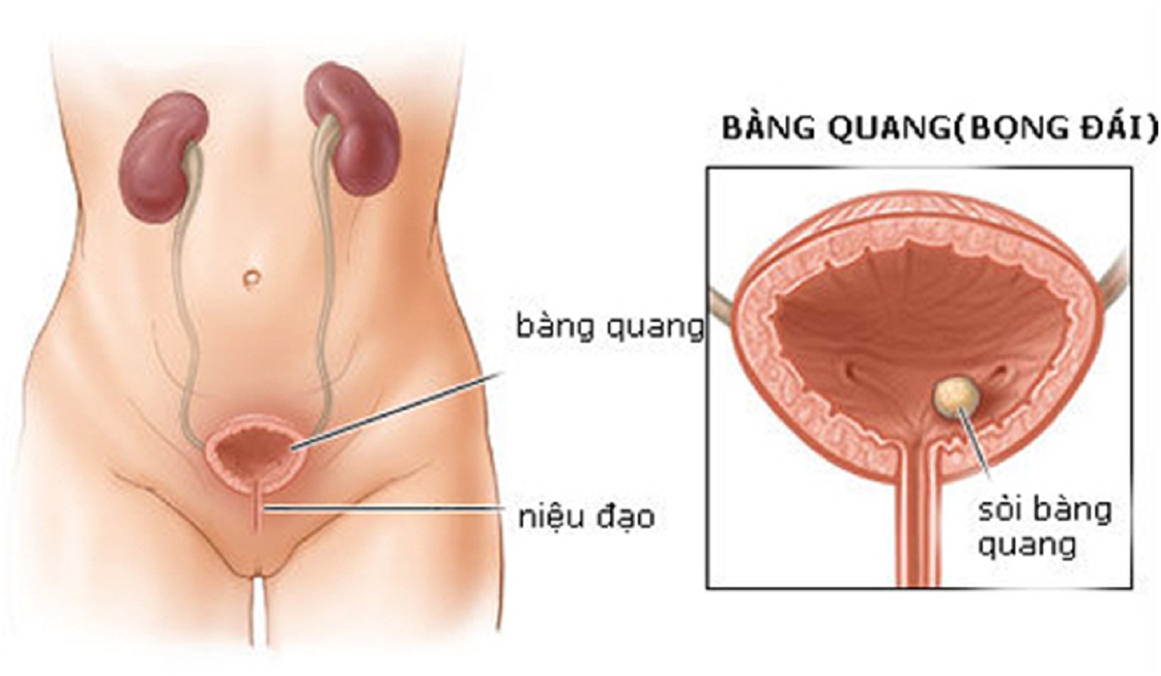 Thời gian điều trị viêm bàng quang bình thường là bao lâu?
