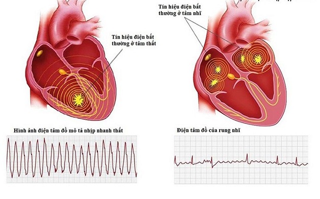 Nguyên lý đo điện tim là gì Những ai cần đo tiện tim