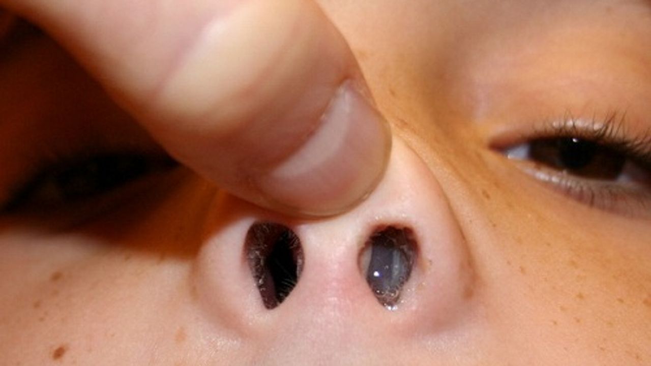 Polyp mũi ở trẻ em: Kiến thức dành cho các bậc phụ huynh | TCI ...