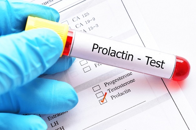Prolactin là một hormone quan trọng trong cơ thể con người, chỉ số này có thể dao động trong ngày