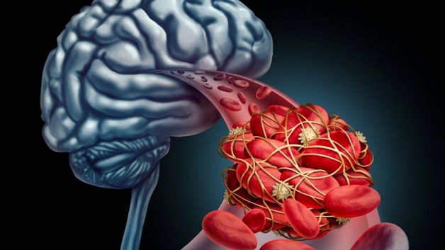 Tại sao thiếu máu não gây đau đầu?