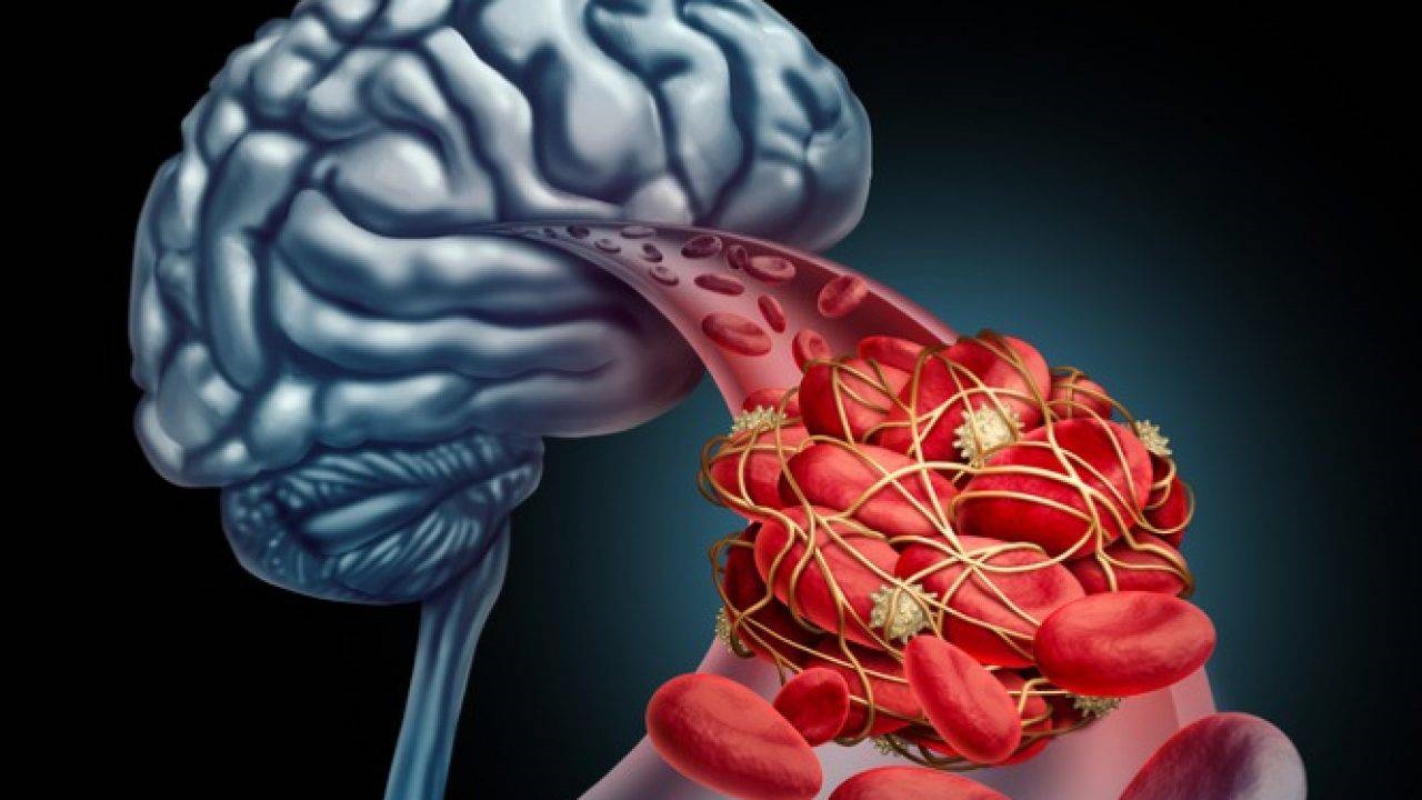 Nhức đầu do thiếu máu não là gì?

