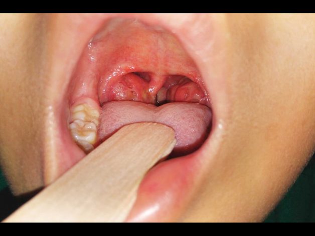 Liên hệ giữa điều trị amidan và phương pháp phẫu thuật bằng coblator