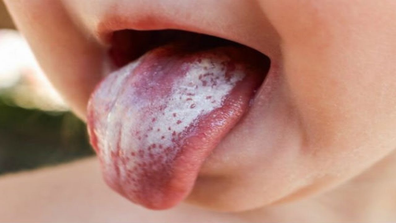  Nhiệt miệng lưỡi ở trẻ em : Nguyên nhân và biện pháp điều trị hiệu quả