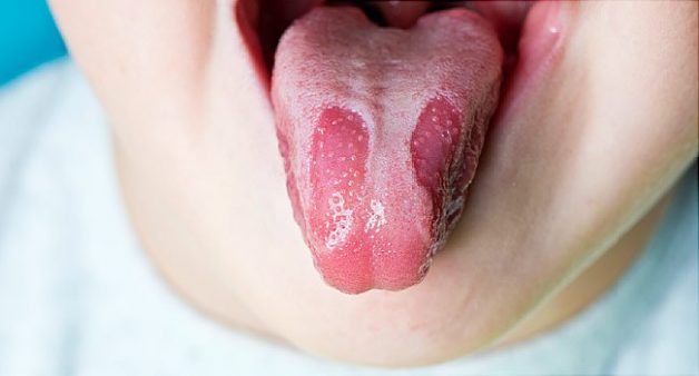 Phân biệt bệnh viêm lưỡi bản đồ và viêm loét lưỡi ở trẻ?
