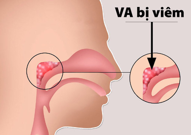 khi các vi khuẩn tấn công cơ thể với số lượng lớn thì các tế bào bạch cầu tại VA không đủ sức chống đỡ gây ra viêm VA ở trẻ.