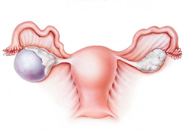 U nang buồng trứng phải là một dạng phổ biến của u nang buồng trứng, chiếm khoảng 3,6% các bệnh phụ khoa.