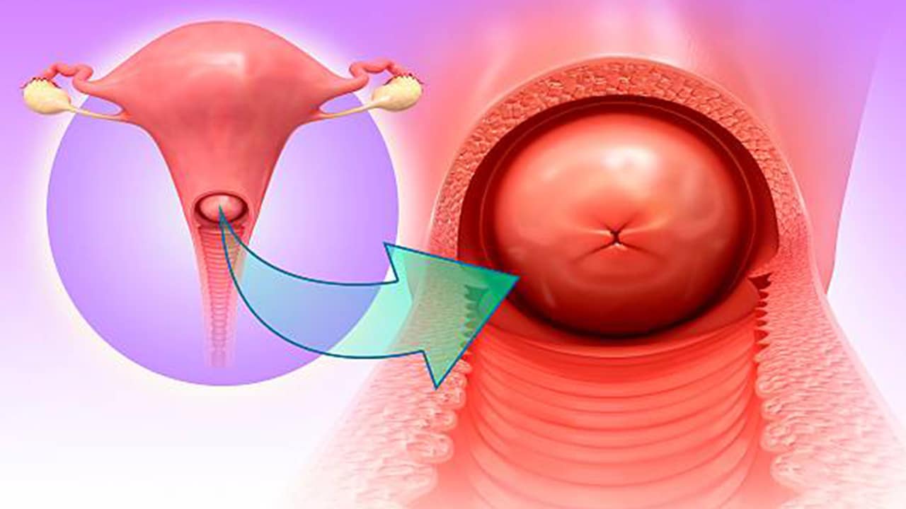 Các thuốc kháng sinh trong viêm cổ tử cung có tác dụng tiêu diệt vi khuẩn gây viêm như thế nào?
