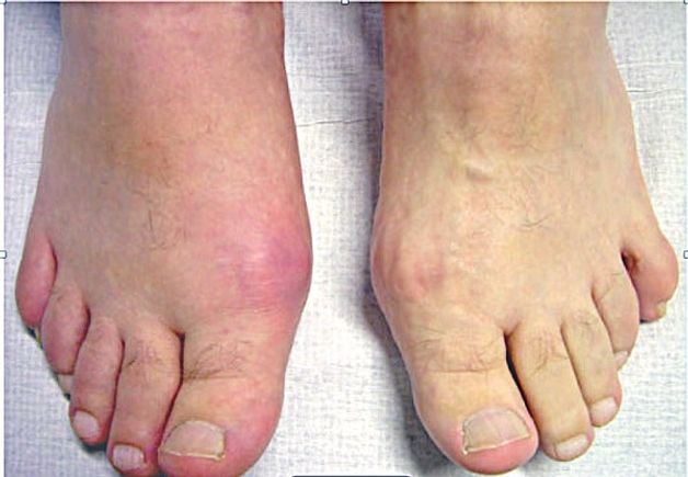 biến chứng của đau khớp ngón chân