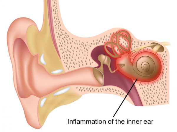 viêm ống tai trong