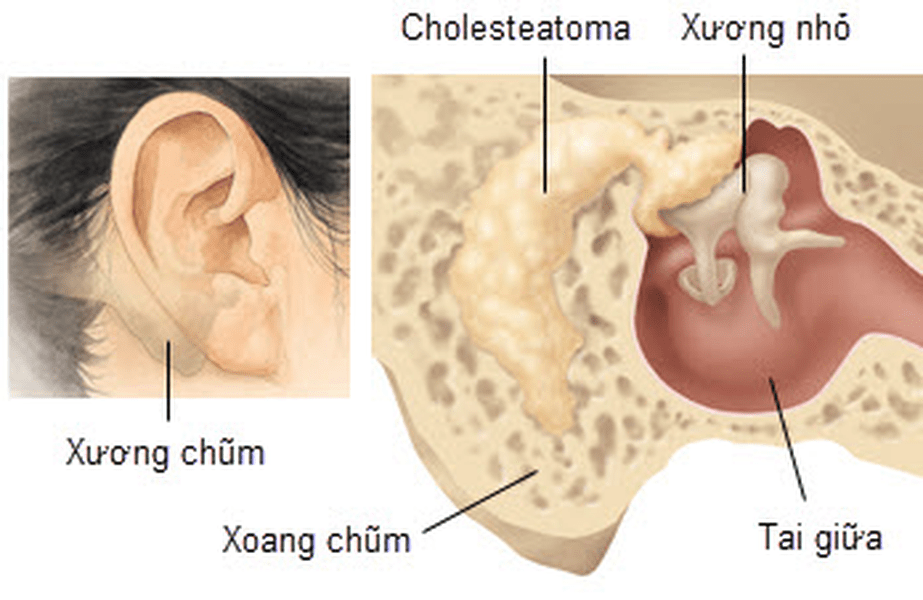 Tìm hiểu về viêm tai xương chũm ở trẻ em | TCI Hospital