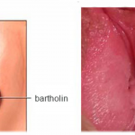Hình ảnh viêm tuyến Bartholin và phương pháp điều trị