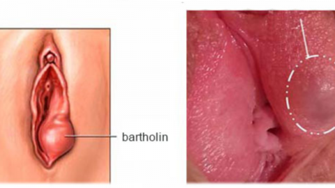 Hình ảnh viêm tuyến Bartholin và phương pháp điều trị