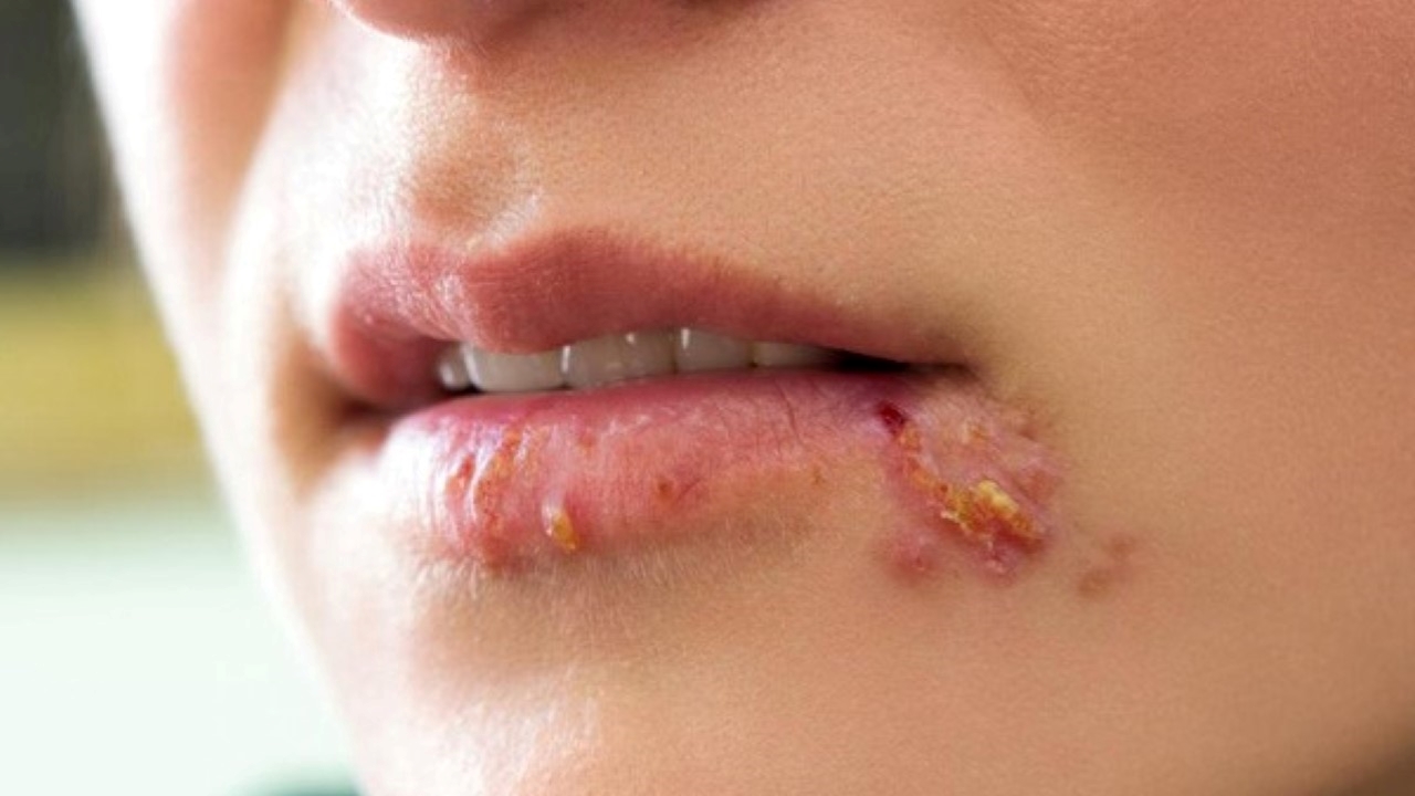 Hình ảnh bệnh herpes miệng như thế nào?