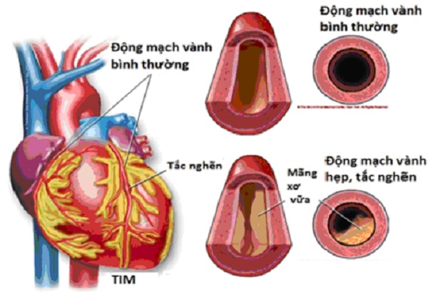 Bệnh mạch vành là căn bệnh phổ biến nhất ở động mạch vành tim.