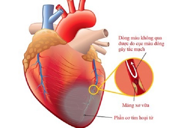 Bệnh mạch vành cấp thường do sự tắc nghẽn đột ngột của động mạch vành gây ra bởi các mảng xơ vữa và huyết khối.
