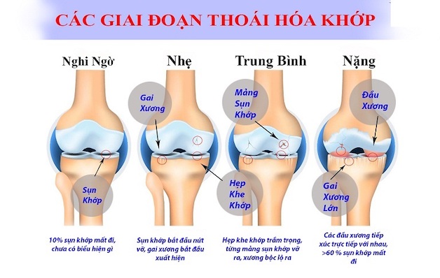 Viêm Thoái Hóa Khớp Gối Ở Người Cao Tuổi