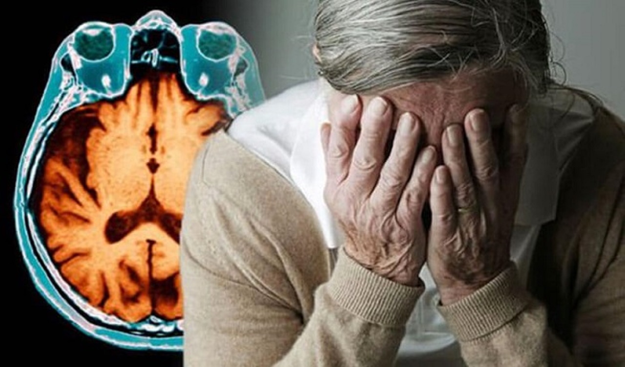 Có cách nào để ngăn ngừa bệnh Alzheimer không?
