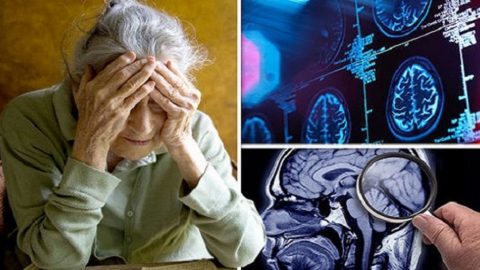 Bệnh alzheimer là gì? Nguyên nhân, triệu chứng, đối tượng