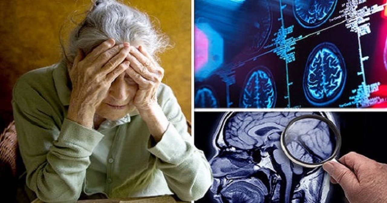 Bệnh lý của Alzheimer diễn tiến như thế nào?
