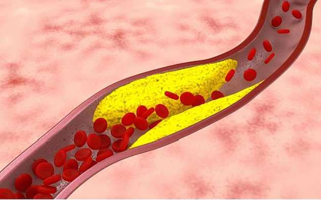 Xơ vữa mạch vành là tình trạng hình thành các mảng bám ở động mạch vành gây trở sự lưu thông của dong máu qua đây.