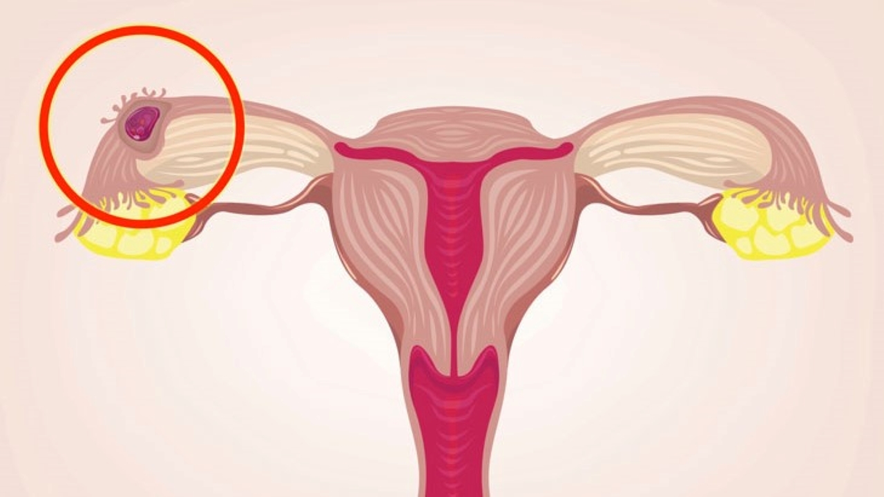 Mang thai ngoài tử cung có ảnh hưởng đến sức khỏe của mẹ không?
