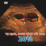 Hình ảnh siêu âm bóc tách túi thai: Có thực sự nguy hiểm?