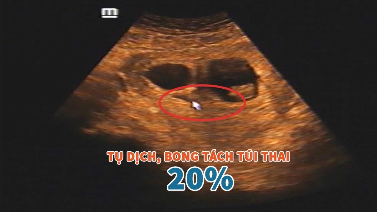 Bóc tách túi thai là phương pháp can thiệp thai kỳ để cứu sống thai nhi khi có các vấn đề khó khăn trong quá trình mang thai. Nếu bạn muốn hiểu sâu hơn về kỹ thuật này, hãy xem hình ảnh liên quan đến bóc tách túi thai và tìm hiểu những thông tin liên quan đến chủ đề này.
