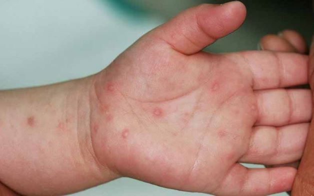 Bệnh tay chân miệng ở trẻ em là một trong những bệnh được gây ra bởi những nhóm virus coxsackie. Đây là bệnh phổ biến ở trẻ em, đặc biệt là trẻ nhỏ dưới 4 tuổi