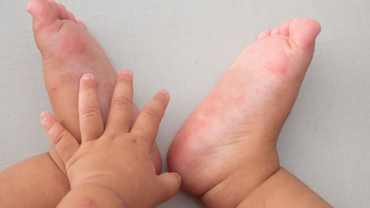Bệnh tay chân miệng ở trẻ em: Triệu chứng và cách chăm sóc đúng cách?