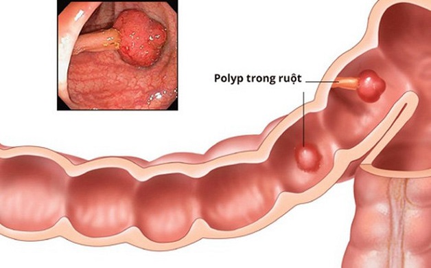 Bệnh ung thư đại trực tràng có nguy hiểm không - polyp