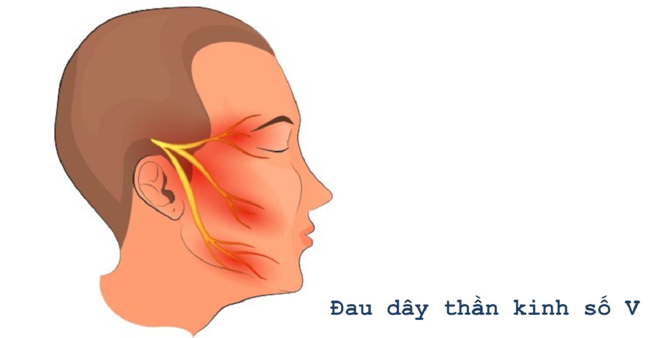 Các bệnh lý thần kinh vùng mặt có thể ảnh hưởng tới chức năng nói chuyện và nhai nuốt không?
