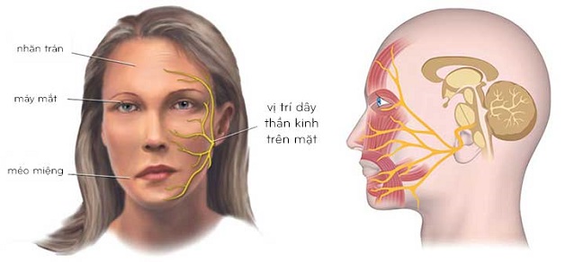 Hiểu đúng về viêm dây thần kinh số 7 | TCI Hospital